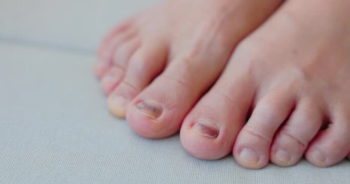Subungual Hematoma on toenail are injuries of wearing shoes that are too tight in which bleeding develops under the nail. Crush injury to the distal phalanx fingernail or toenail, black toenail. 4k.