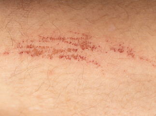 scratches on the skin of the leg as a background.