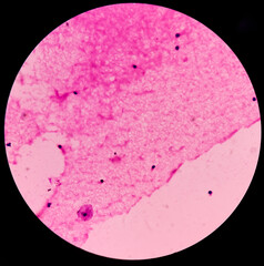 Scrotal hydrocele(FNA cytology): microscopic image shows lymphocytes and hostiocytes. background of fluidy material. no malignant cell present. scrotal swelling or testicular pain.