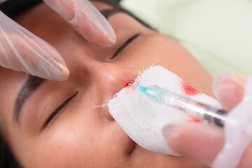 Example of nose thread lift. Plastic surgeon injects threads to lift, straighten or slim the nose...