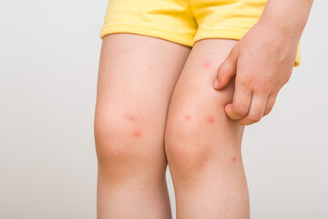 Toddler girl hand fingers itching red rash on leg skin from bite of mosquito or food allergy isolated on light gray background. Front view. Closeup.