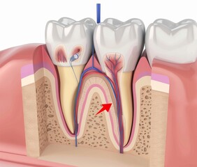 An illustration of the endodontic root canal treatment process in 3D.