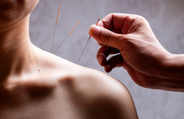 Doctors perform acupuncture and moxibustion treatment for women's shoulders