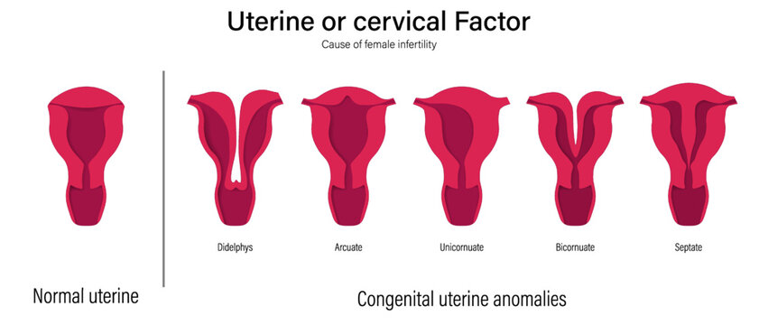 Female infertility vector. Comparison of normal uterine and congenital uterine anomalies. Uterine factor. Didelphys, Arcuate, Unicornuate, Bicornuate and Septate.