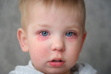 Red swollen eyes from conjunctivitis child, ill allergic eyes in babies. Close-up of a baby with conjunctivitis