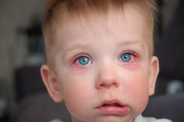 Red swollen eyes from conjunctivitis child, ill allergic eyes in babies. Close-up of a baby with conjunctivitis