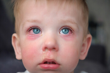 Red swollen eyes from conjunctivitis child, ill allergic eyes in babies. Close-up of a baby with conjunctivitis