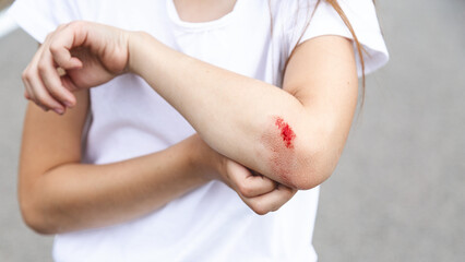The girl cut her elbow after falling from a scooter