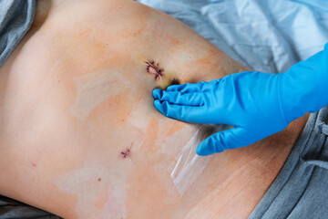 Hands of medic or nurse in blue gloves examining a fresh suture on a male stomach after laparoscopy...