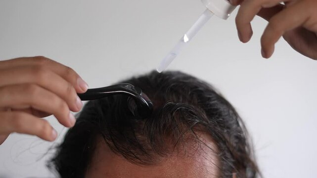 man using roller hair on his scalp to prevent baldness,  Receding hairline