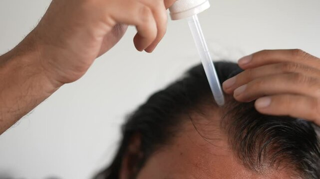 man applying minoxidil to hair with dropper, baldness, Thinning hair