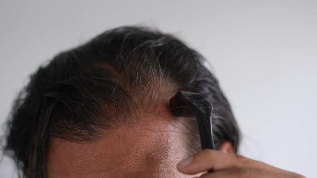 man using roller hair on his scalp to prevent baldness, Bald patches
