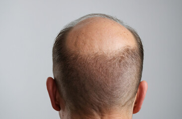 Fototapeta premium close up of a person bald head with hair loss problem