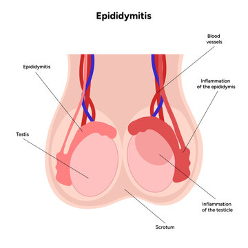 Medical diagram Epididymitis mans disease