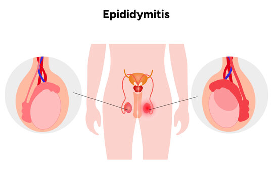 Medical diagram Epididymitis mans disease