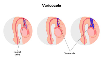 Obraz premium Normal vein Varicocele zoom, medical infographic 