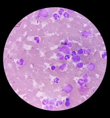 Bone marrow study (BMS).Panmyelosis. Myeloproliferative disorder. Acute myeloid leukemia.