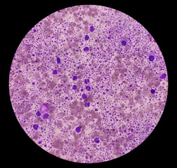 Bone marrow study (BMS).Panmyelosis. Myeloproliferative disorder. Acute myeloid leukemia.