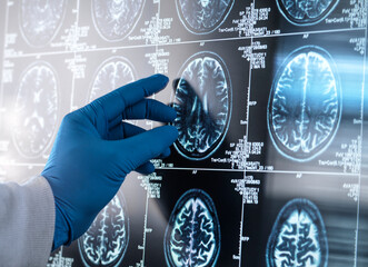 Neurology Research, Doctor viewing a patients MRI Scan for damage