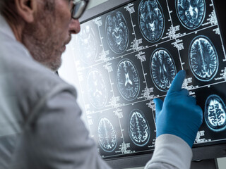 Neurology Research, Doctor viewing a patients MRI brain scan on screen