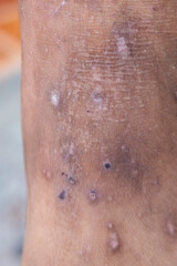 Background image of wounds caused by Systemic Lupus erythematosus (SLE) or Lupus.