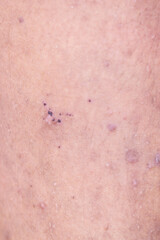 Background image of wounds caused by Systemic Lupus erythematosus (SLE) or Lupus.