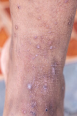 Background image of wounds caused by Systemic Lupus erythematosus (SLE) or Lupus.