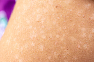 Background image of wounds caused by Systemic Lupus erythematosus (SLE) or Lupus.