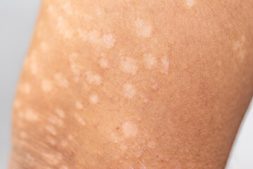 Fototapeta premium Background image of wounds caused by Systemic Lupus erythematosus (SLE) or Lupus.