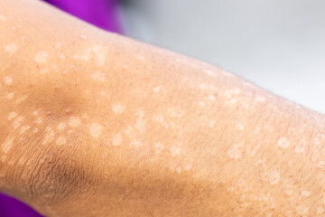 Background image of wounds caused by Systemic Lupus erythematosus (SLE) or Lupus.
