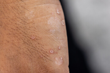 Fototapeta premium Background image of wounds caused by Systemic Lupus erythematosus (SLE) or Lupus.