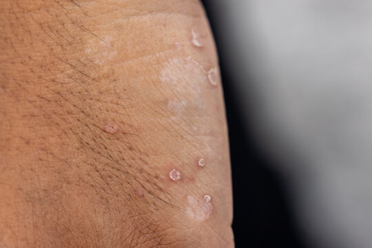 Background image of wounds caused by Systemic Lupus erythematosus (SLE) or Lupus.