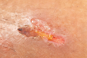Background image of wounds caused by Systemic Lupus erythematosus (SLE) or Lupus.