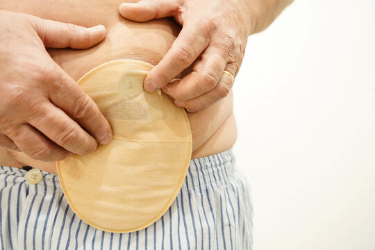 an unrecognizable person putting a stoma bag in the abdomen with copy space