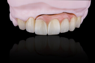 High-quality naturally dental single crowns made of zirconium for fixation to the frontal teeth of upper jaw. © gorynvd