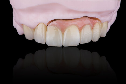High-quality naturally dental single crowns made of zirconium for fixation to the frontal teeth of upper jaw.