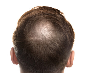 Obraz premium Baldness concept. Man with bald spot on white background, back view