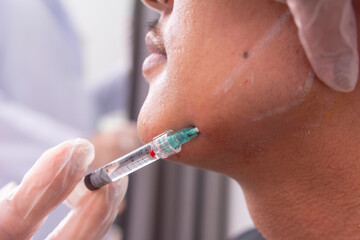 Jawline filler procedure for male patient. Injecting filler gel or hyaluronic acid for a more...