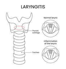 Laryngitis medical design with line style illustration