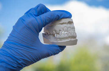 White plaster impression of the dental jaw of a patient with crooked teeth and malocclusion....