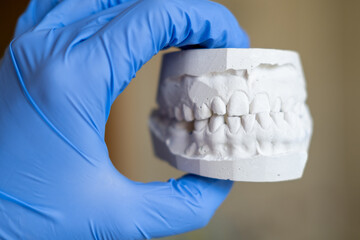 White plaster impression of the dental jaw of a patient with crooked teeth and malocclusion....