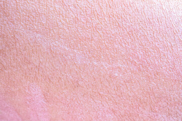 dry and dehydrated human skin texture background