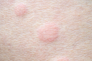 Fototapeta premium Skin allergy rash dermatitis texture close up