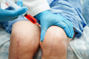Asian doctor inject Hyaluronic acid platelet rich plasma into the knee of senior woman to walk...