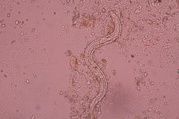 View in microscopic Strongyloides stercoralis or threadworm in human stool.Parasite...