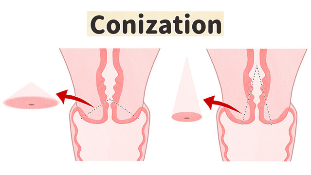 Cervical conization Medical diagram PNG