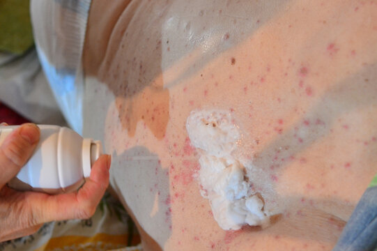 Decubitus ulcer. Pressure ulcers on skin tissue. The increased pressure prevents the blood from circulating properly, and causes cell death, tissue necrosis and the development of pressure ulcers
