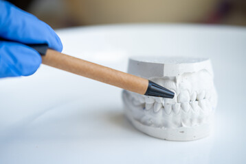 White plaster impression of the dental jaw of a patient with crooked teeth and malocclusion....