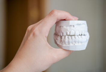 White plaster impression of the dental jaw of a patient with crooked teeth and malocclusion....
