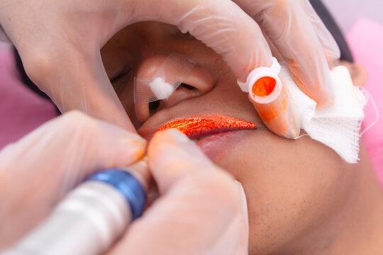 Close-up of a man receiving a lip pigmentation treatment using an orange tint for a brown skin tone. Gauze on nose from prior hiko thread lift.